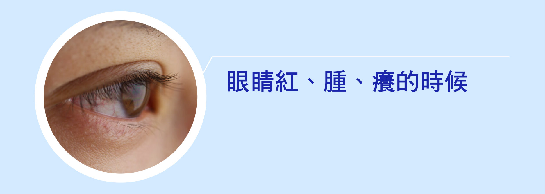 眼睛紅、腫、癢的時候
